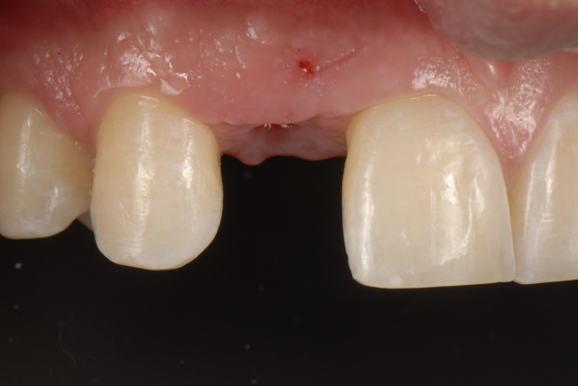 Fabrication of a Single-Tooth Implant Provisional Restoration: A Visual Essay RicardoMitrani fabrication of a single tooth implant provisional restoration Fig.1