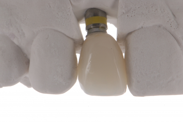 Fabrication of a Single-Tooth Implant Provisional Restoration: A Visual Essay RicardoMitrani fabrication of a single tooth implant provisional restoration Fig.11