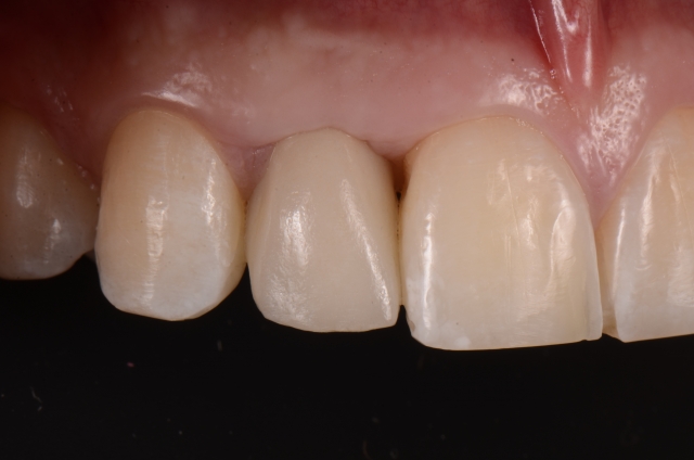 Fabrication of a Single-Tooth Implant Provisional Restoration: A Visual Essay RicardoMitrani fabrication of a single tooth implant provisional restoration Fig.12
