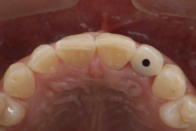 Fabrication of a Single-Tooth Implant Provisional Restoration: A Visual Essay RicardoMitrani fabrication of a single tooth implant provisional restoration Fig.13