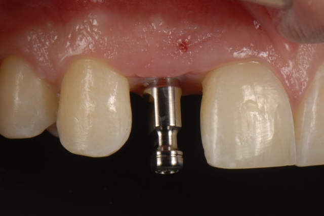 Fabrication of a Single-Tooth Implant Provisional Restoration: A Visual Essay RicardoMitrani fabrication of a single tooth implant provisional restoration Fig.2