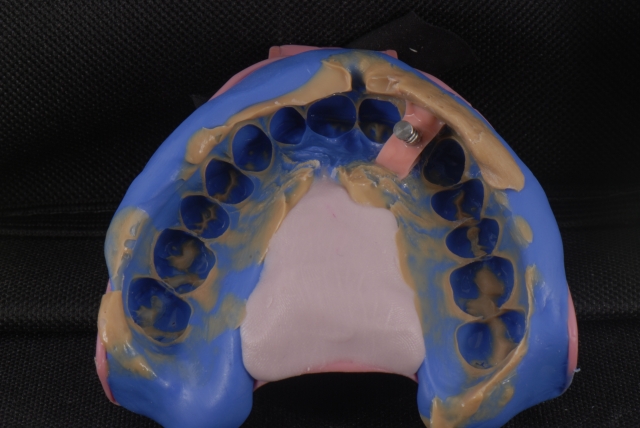 Fabrication of a Single-Tooth Implant Provisional Restoration: A Visual Essay RicardoMitrani fabrication of a single tooth implant provisional restoration Fig.3