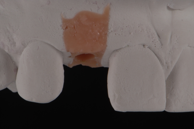 Fabrication of a Single-Tooth Implant Provisional Restoration: A Visual Essay RicardoMitrani fabrication of a single tooth implant provisional restoration Fig.4