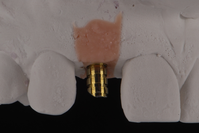 Fabrication of a Single-Tooth Implant Provisional Restoration: A Visual Essay RicardoMitrani fabrication of a single tooth implant provisional restoration Fig.5