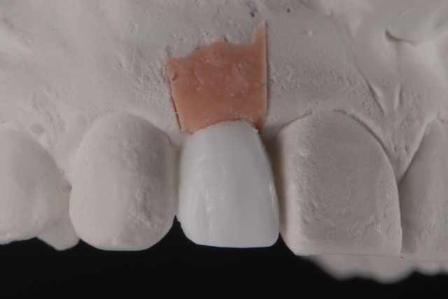 Fabrication of a Single-Tooth Implant Provisional Restoration: A Visual Essay RicardoMitrani fabrication of a single tooth implant provisional restoration Fig.6