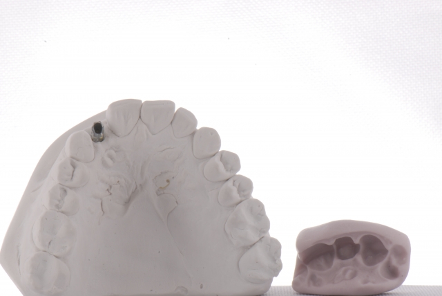 Fabrication of a Single-Tooth Implant Provisional Restoration: A Visual Essay RicardoMitrani fabrication of a single tooth implant provisional restoration Fig.7