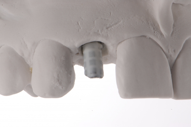 Fabrication of a Single-Tooth Implant Provisional Restoration: A Visual Essay RicardoMitrani fabrication of a single tooth implant provisional restoration Fig.8