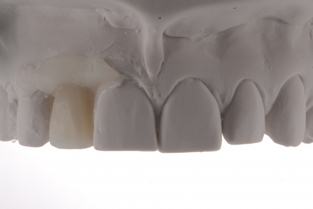 Fabrication of a Single-Tooth Implant Provisional Restoration: A Visual Essay RicardoMitrani fabrication of a single tooth implant provisional restoration Fig.9