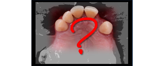 RicardoMitrani terminal dentition where do we draw the line FeaturedImage
