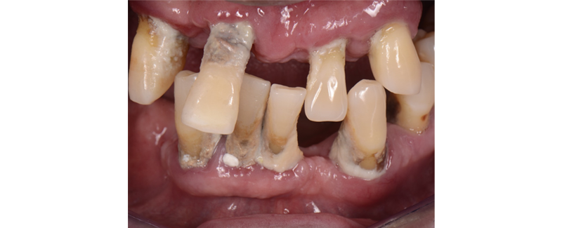 Terminal Dentition: Where Do We Draw the Line? RicardoMitrani terminal dentition where do we draw the line Fig.2