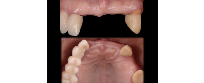 Terminal Dentition: Where Do We Draw the Line? RicardoMitrani terminal dentition where do we draw the line Fig.3