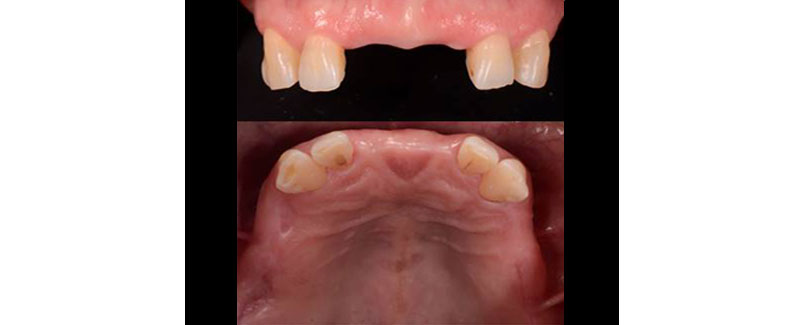 Terminal Dentition: Where Do We Draw the Line? RicardoMitrani terminal dentition where do we draw the line Fig.4
