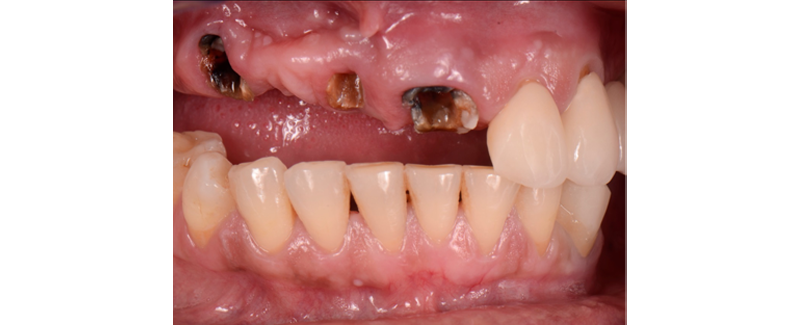 Terminal Dentition: Where Do We Draw the Line? RicardoMitrani terminal dentition where do we draw the line Fig.5