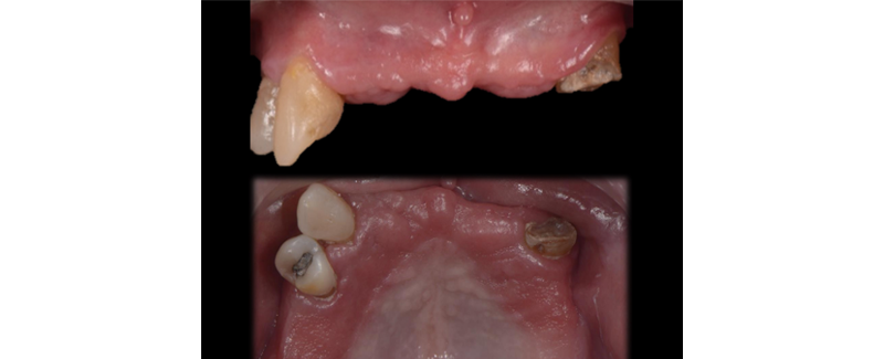 Terminal Dentition: Where Do We Draw the Line? RicardoMitrani terminal dentition where do we draw the line Fig.6