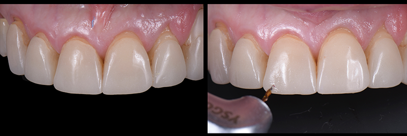 RicardoMitrani utilizing laser to remove ceramic veneers Fig.10
