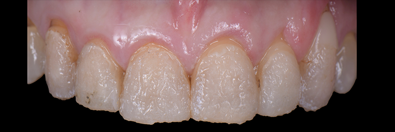 RicardoMitrani utilizing laser to remove ceramic veneers Fig.11