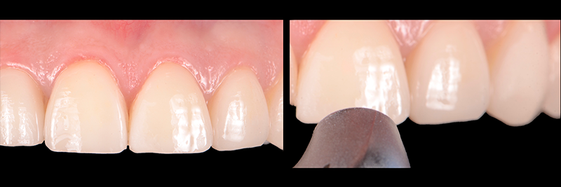 RicardoMitrani utilizing laser to remove ceramic veneers Fig.2