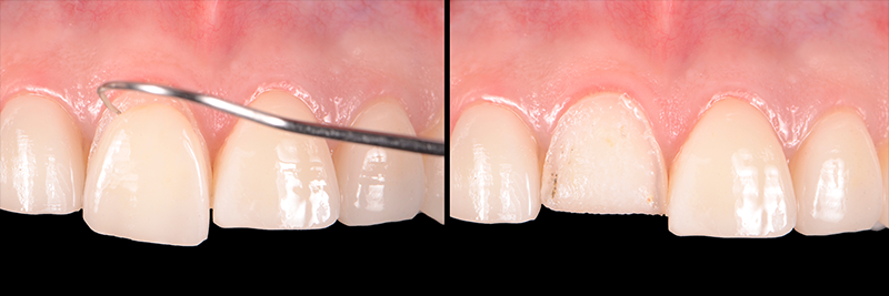 RicardoMitrani utilizing laser to remove ceramic veneers Fig.3