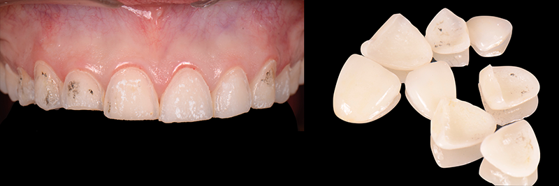 RicardoMitrani utilizing laser to remove ceramic veneers Fig.4