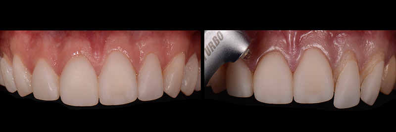 RicardoMitrani utilizing laser to remove ceramic veneers Fig.5