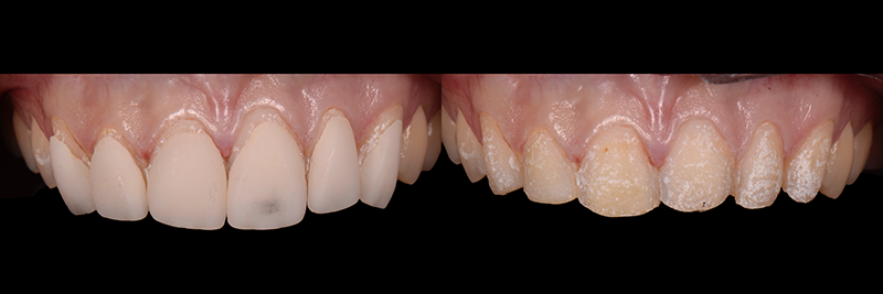 RicardoMitrani utilizing laser to remove ceramic veneers Fig.6
