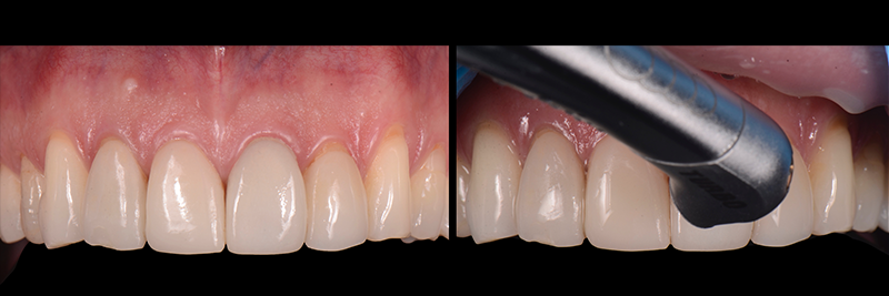 RicardoMitrani utilizing laser to remove ceramic veneers Fig.7
