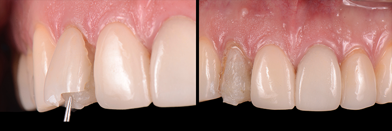 RicardoMitrani utilizing laser to remove ceramic veneers Fig.8