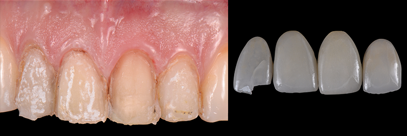 RicardoMitrani utilizing laser to remove ceramic veneers Fig.9