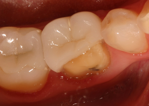 Robert Winter Ceramic Restorations Why Do They Break Featured Image