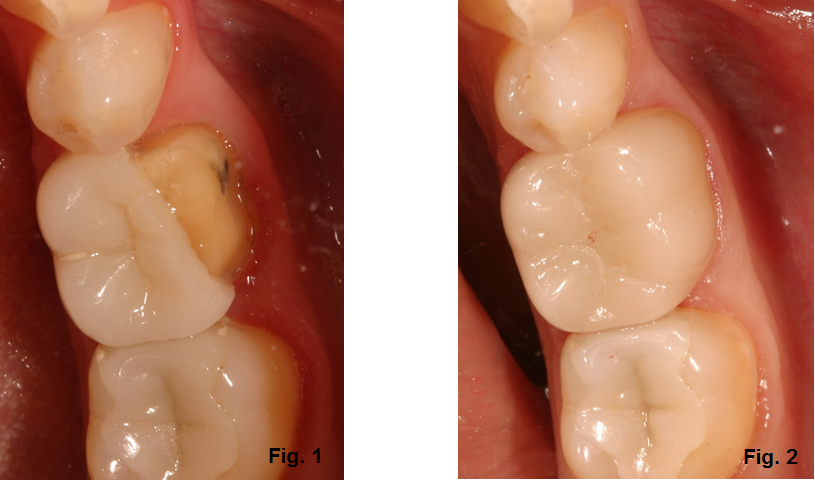 Ceramic Restorations: Why Do They Break? Robert Winter Ceramic Restorations Why Do They Break Figure 1 2