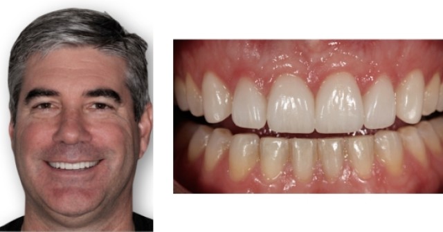 Evaluating Occlusal Cant Problems During the Restoration Try-In Robert Winter Evaluating Occlusal Cant Problems During the Restoration Try In Featured Image