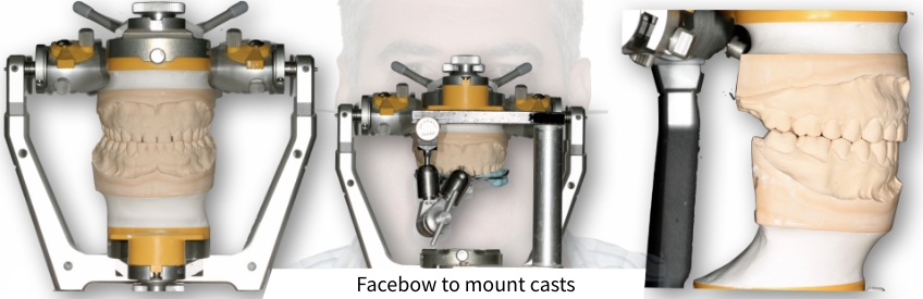 Evaluating Occlusal Cant Problems During the Restoration Try-In Robert Winter Evaluating Occlusal Cant Problems During the Restoration Try In Figure 1