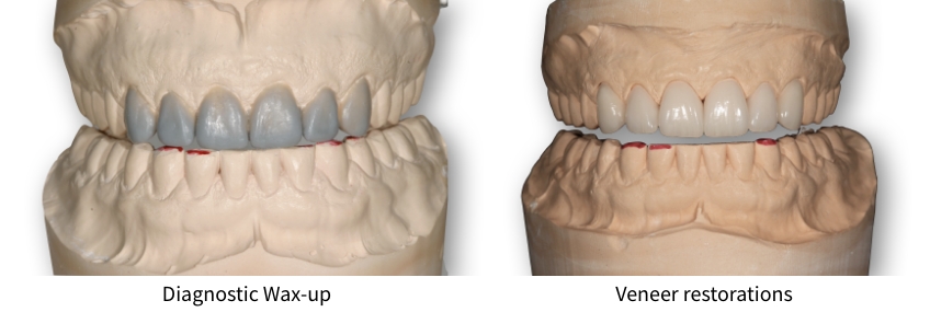 Evaluating Occlusal Cant Problems During the Restoration Try-In Robert Winter Evaluating Occlusal Cant Problems During the Restoration Try In Figure 2
