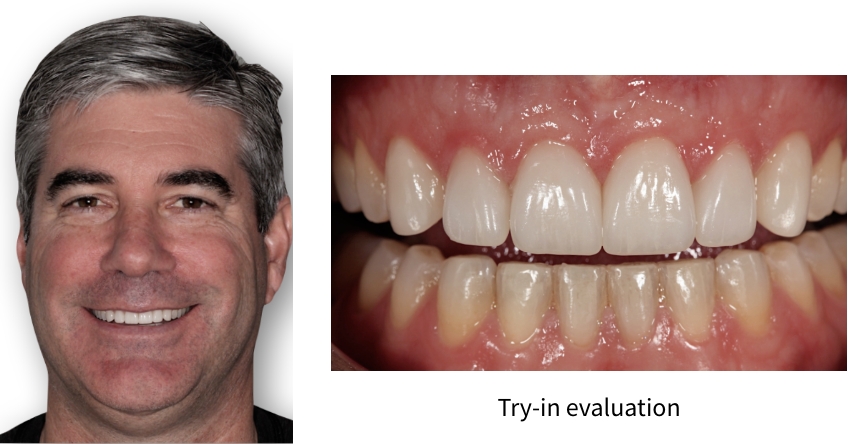Evaluating Occlusal Cant Problems During the Restoration Try-In Robert Winter Evaluating Occlusal Cant Problems During the Restoration Try In Figure 3