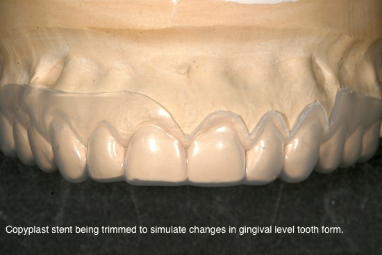 Copyplast Robert Winter Fabricating Surgical Guides Figure 1