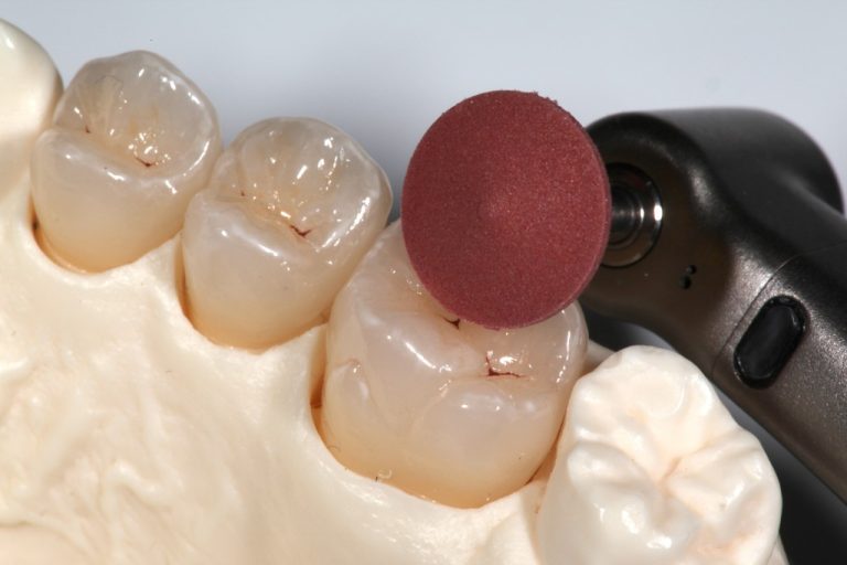 Clinical Tips for Polishing Ceramics: e.max and Zirconia
