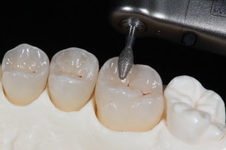 Clinical Tips for Polishing Ceramics: e.max and Zirconia Robert Winter Polishing Ceramics e.max and Zirconia Fig1