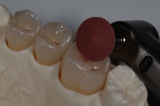 Clinical Tips for Polishing Ceramics: e.max and Zirconia Robert Winter Polishing Ceramics e.max and Zirconia Fig2