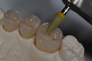 Clinical Tips for Polishing Ceramics: e.max and Zirconia Robert Winter Polishing Ceramics e.max and Zirconia Fig3