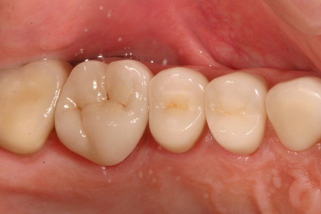 Recommendations for Monolithic Translucent Zirconia Restorations Robert Winter Recommendations for Monolithic Translucent Zirconia Restorations Featured Image