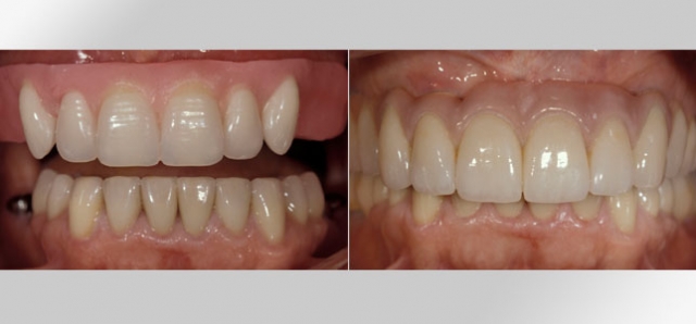 Steps for Fabrication of an Implant-Supported Prosthesis Robert Winter Steps for Fabrication of an Implant Support Prosthesis fig.1