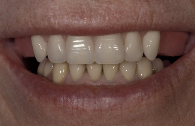 Steps for Fabrication of an Implant-Supported Prosthesis Robert Winter Steps for Fabrication of an Implant Support Prosthesis fig.2