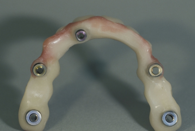 Steps for Fabrication of an Implant-Supported Prosthesis Robert Winter Steps for Fabrication of an Implant Support Prosthesis fig.3