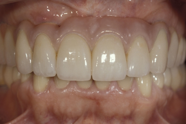 Steps for Fabrication of an Implant-Supported Prosthesis Robert Winter Steps for Fabrication of an Implant Support Prosthesis fig.4