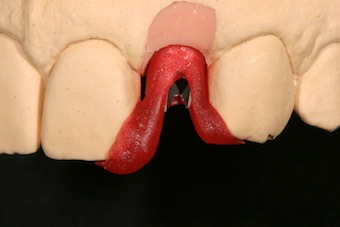 Using an Implant Abutment Placement Jig Robert Winter Using an Implant Abutment Placement Jig Figure 1