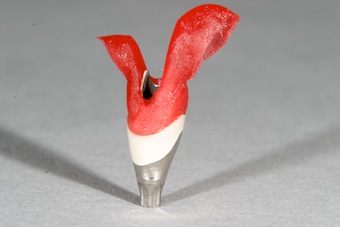 Using an Implant Abutment Placement Jig Robert Winter Using an Implant Abutment Placement Jig Figure 2