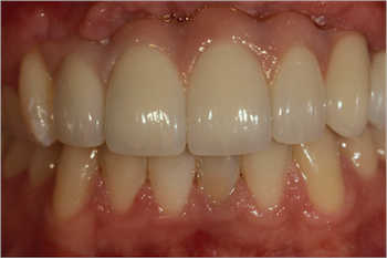 Pink Ceramic vs. Pink Composite for Soft Tissue Simulation RobertWInter pink ceramic vs pink composite for soft tissue simulation Fig.1