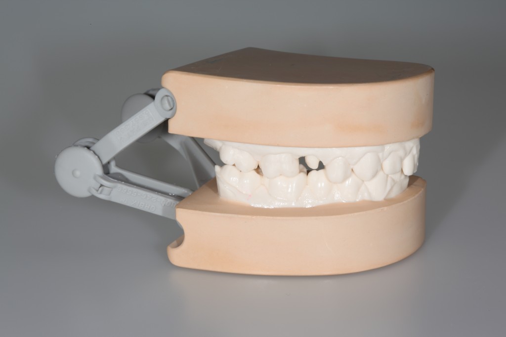 When To Use Triple-Tray Impressions RobertWinter When to Use Triple Tray Impressions Fig.1