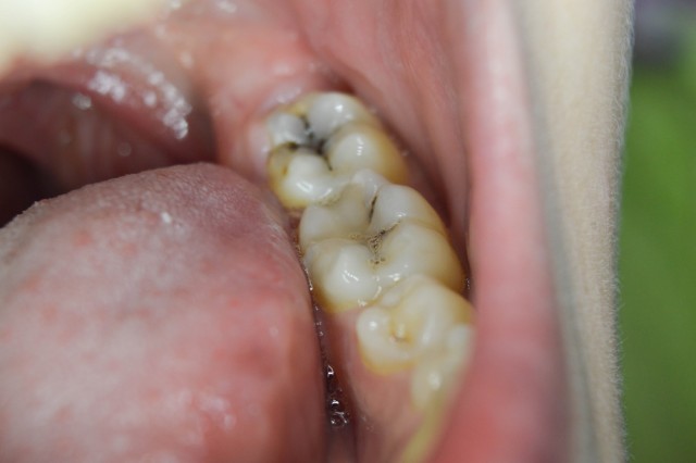 RobertWinter complete vs incomplete caries removal risk of complications and failure FeaturedImage
