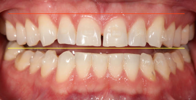 Diagnostic Wax-Up Fabrication: Pre-Restorative Treatment and Ortho RobertWinter diagnostic wax up fabrication pre restorative treatment and ortho Fig.1
